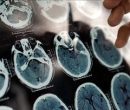 تشخیص زودهنگام آلزایمر در افراد با گوشی و ساعت هوشمند