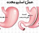 بهترین جراح اسلیو معده در تهران کیست؟ ۵ جراح برتر و نکات انتخاب آن