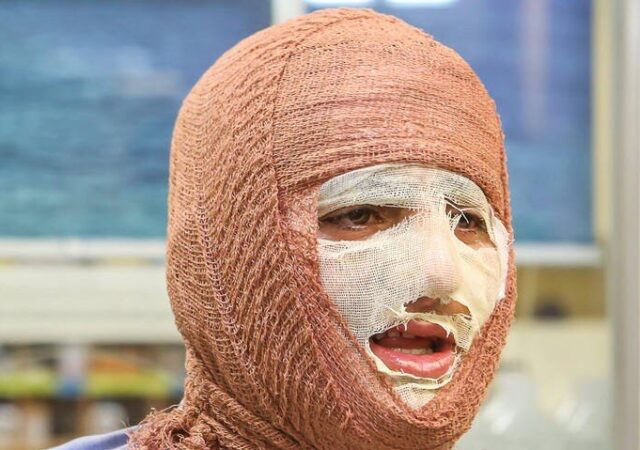 آیا بهبود کامل پس از سوختگی‌های عمیق امکان‌پذیر است؟