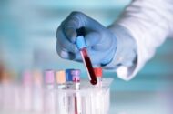 تاثیر آزمایش خون مبتنی بر DNA بر درمان سرطان گلو