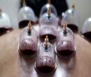 حجامت توسط افراد غیر متخصص خطرناک است