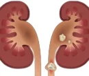 سنگ کلیه چه علائمی دارد؟